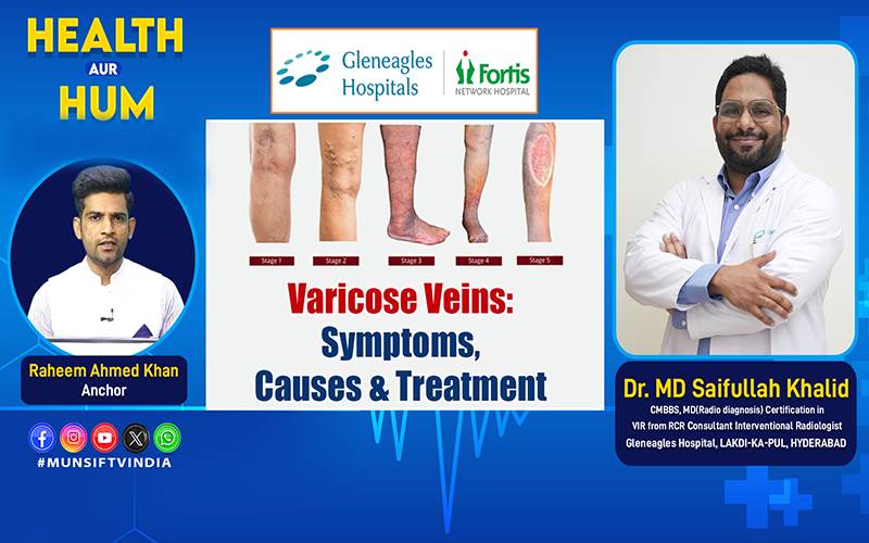 وریکوز وینز کیا ہے؟ علامات، اسباب اور جدید علاج